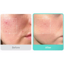 Load image into Gallery viewer, medicube Azelaic Acid 16 BB Calming Serum 30ml
